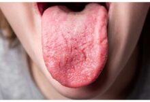 Photo of जीभ पर दिखते हैं विटामिन-B12 की कमी के 3 बड़े संकेत