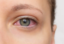 Photo of जिसे साधारण एलर्जी समझ रहे हैं, कहीं वो अर्बन आई सिंड्रोम तो नहीं?